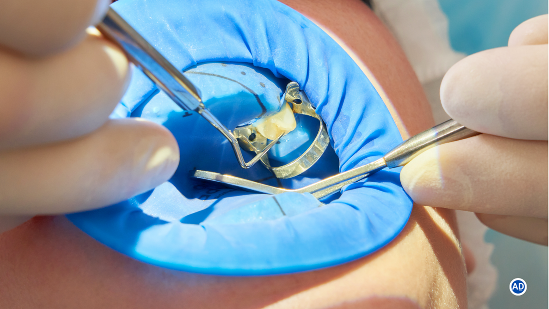 Dental Composite Placement