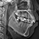 Airway-Centered Orthodontics: Utilizing CBCT and Sleep Studies for Early Intervention.