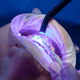 5 Common Mistakes Dentists Make When Using Curing Lights (And How to Avoid Them)
