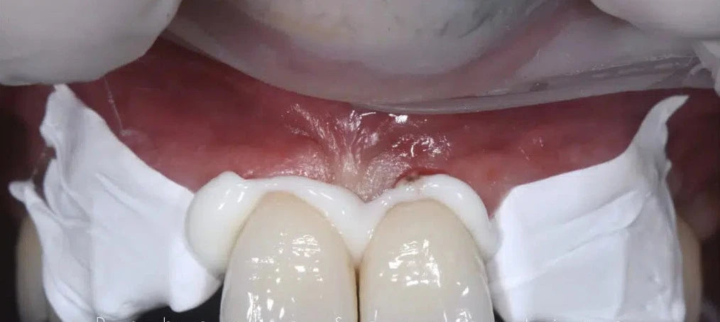 PTFE Isolation Tape - High-Quality Sealant for Dental Use