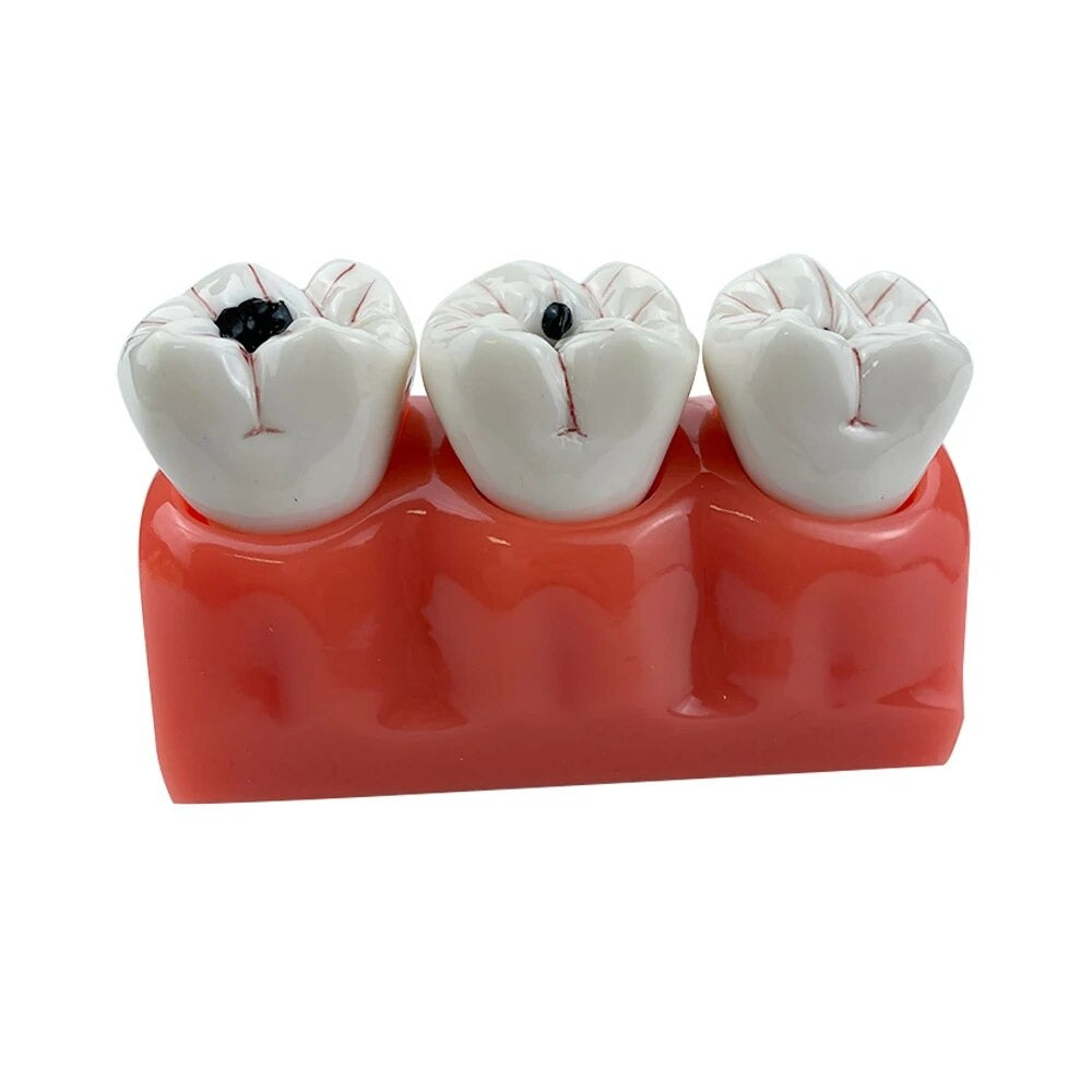 Dental Mode - Stages of dental caries