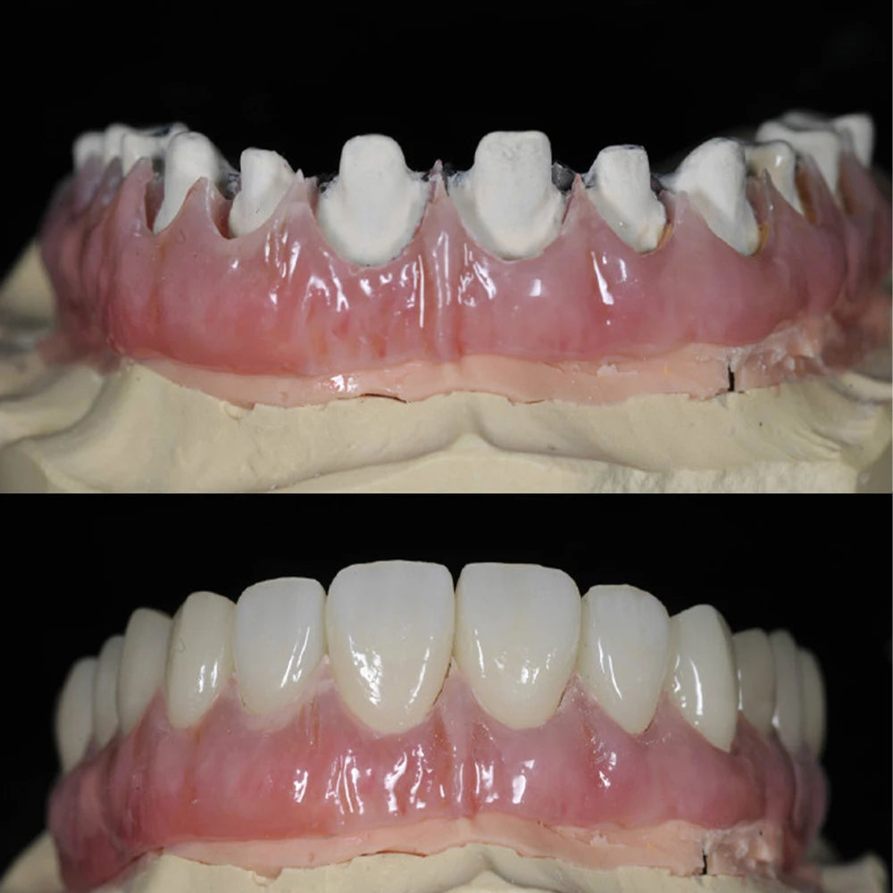 Monochrome Hybrid Ceramic - Resin Based Restoration