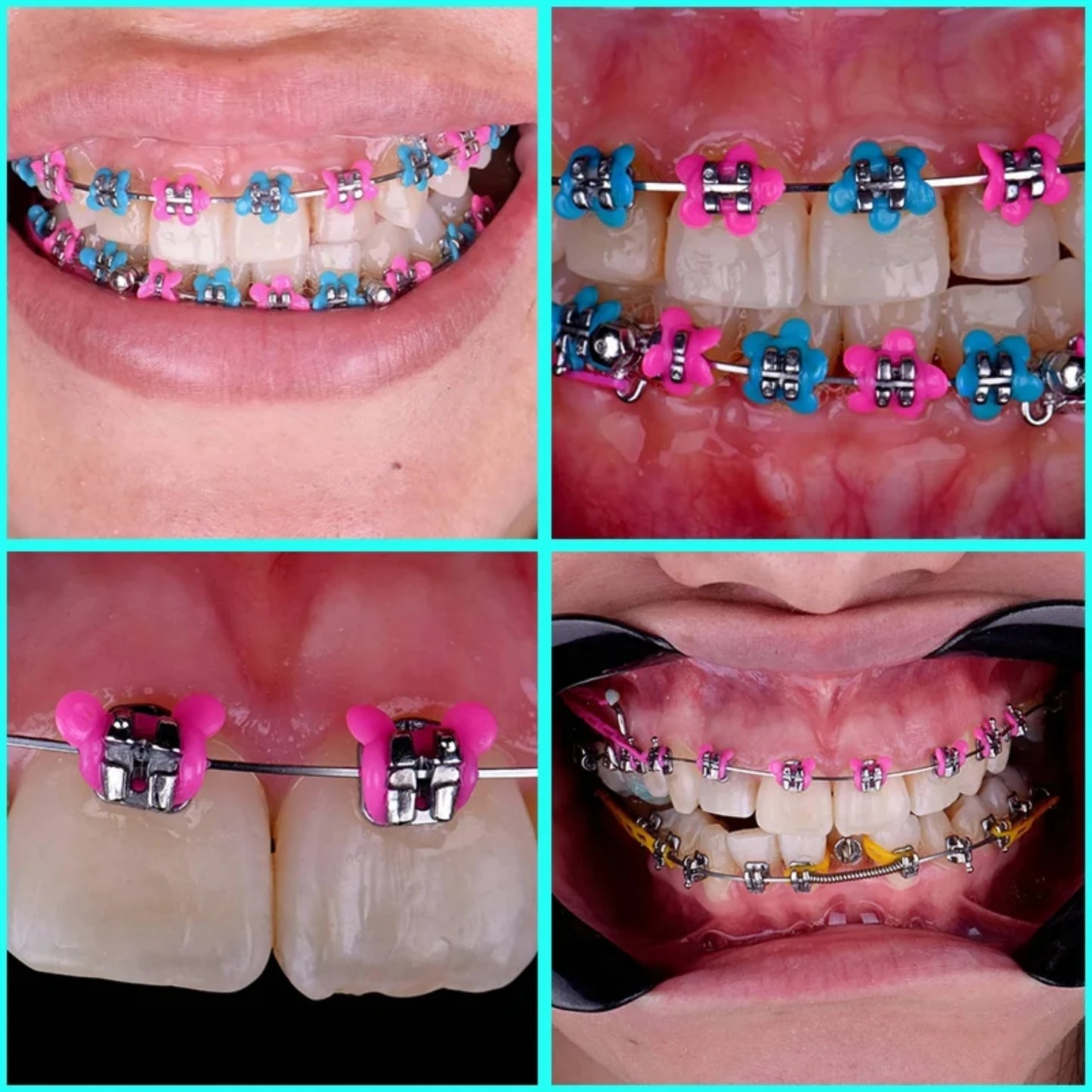 Character Orthodontic Ligature Ties - 1000 Pcs/Pack!