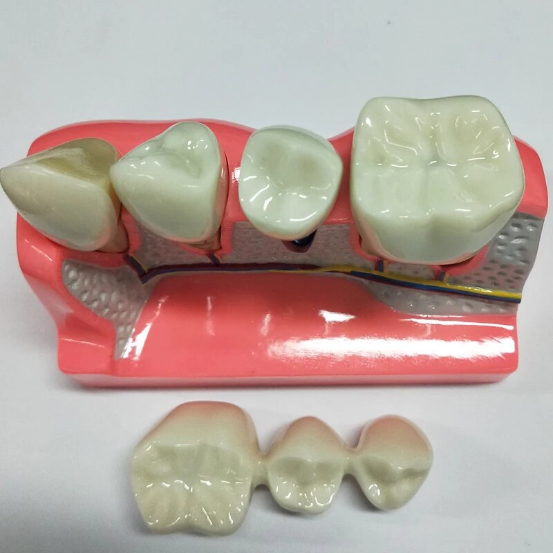 a dental model of a tooth with three teeth