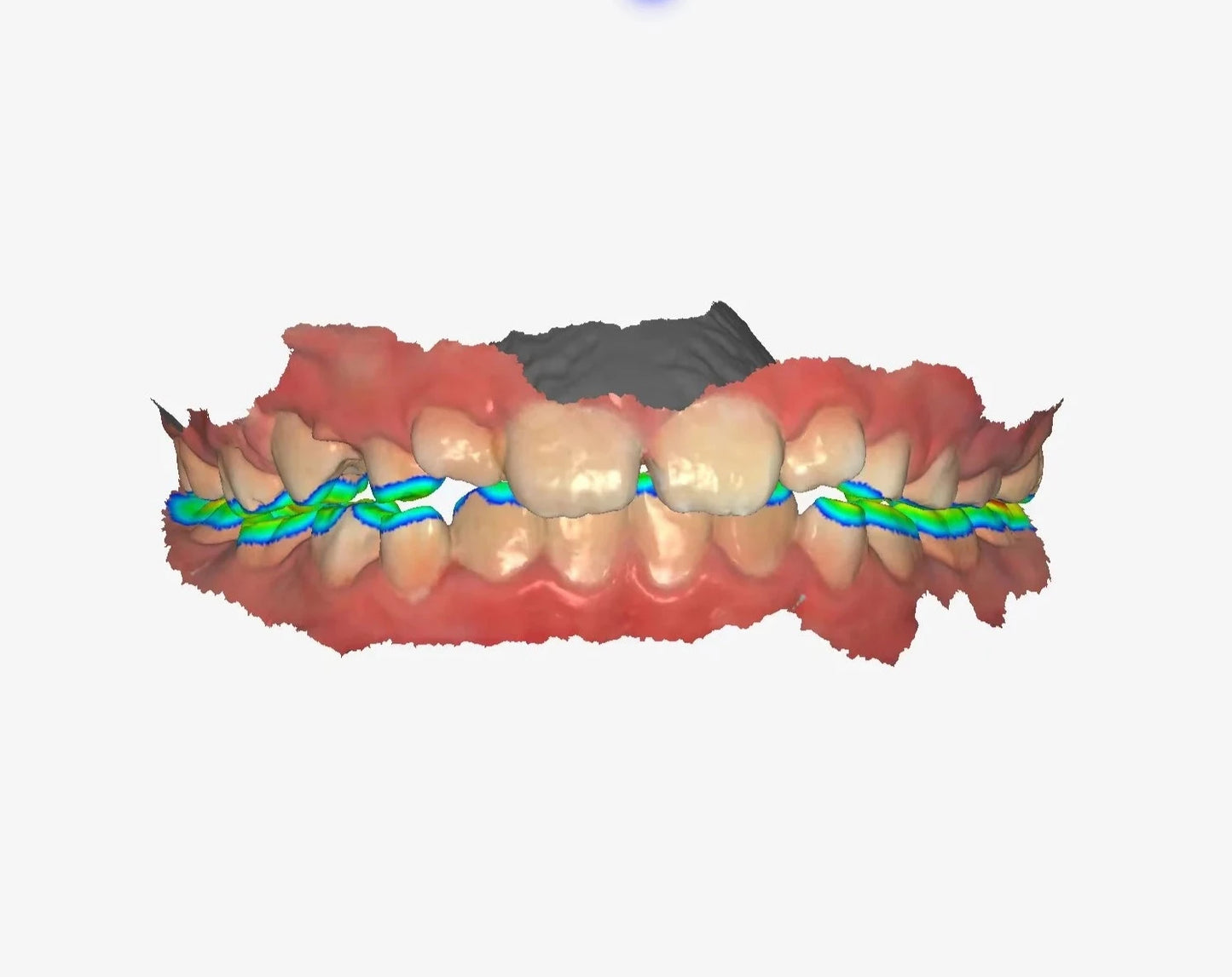 intraoral scanner