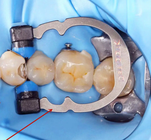Titanium Dental Matrix Ring System - Small & Medium Clamps for Molar & Premolar - Garrison Compatible