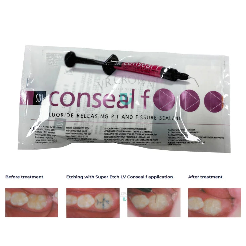 SDI Pit & Fissure Sealants, Fluoride-Releasing Kit - 3pcs or 6pcs