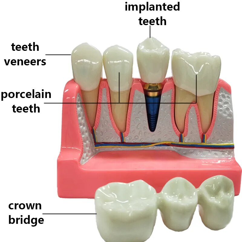 a diagram of a dental model of a tooth