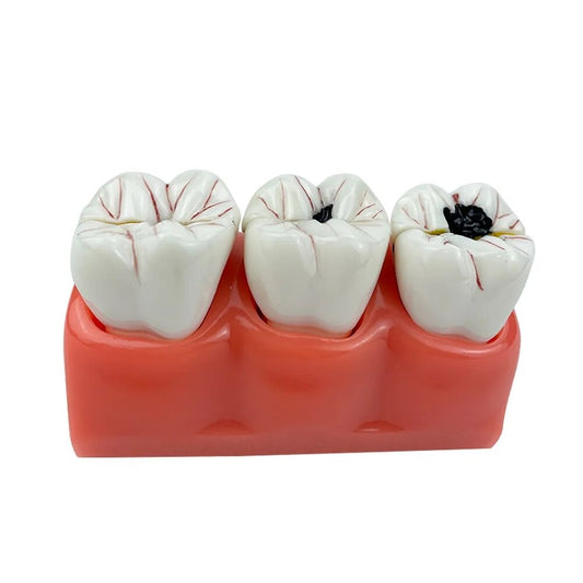 Dental Mode - Stages of dental caries