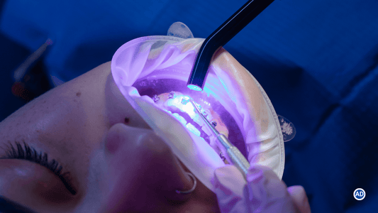 5 Common Mistakes Dentists Make When Using Curing Lights (And How to Avoid Them)