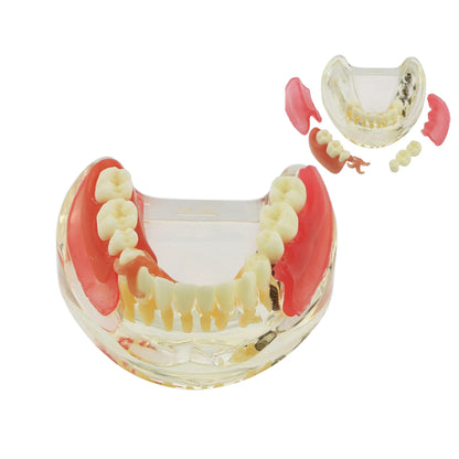 Dental Removable Bridge Partial Tooth Implant Model