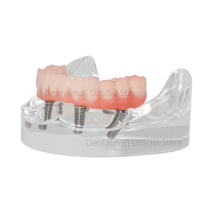 Mandibular Arch Fixed Implant Protheses Restoration Model - complete arch