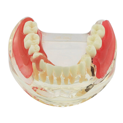 Dental Removable Bridge Partial Tooth Implant Model