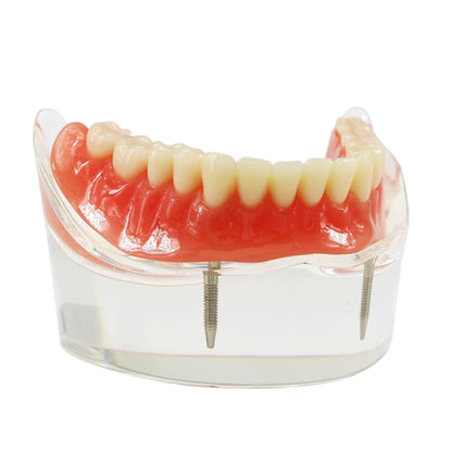 Dental Model M6002 Implant Overdenture Study Base