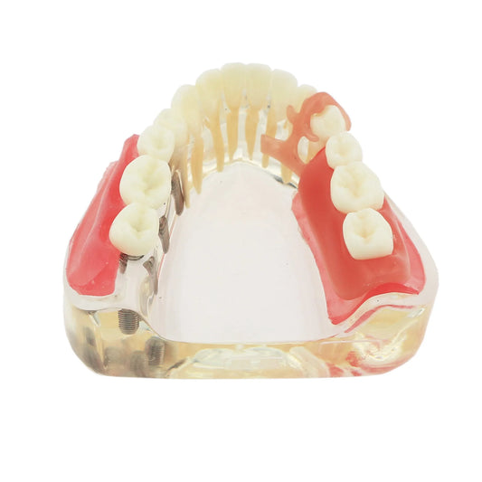 Dental Removable Bridge Partial Tooth Implant Model