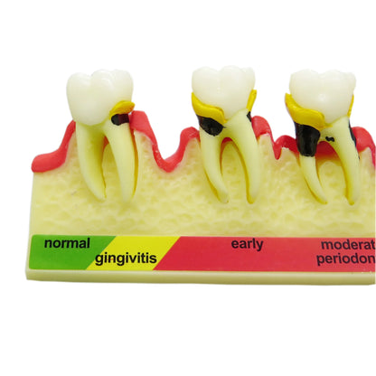 Dental Periodontal Disease Progression Model PER 4010