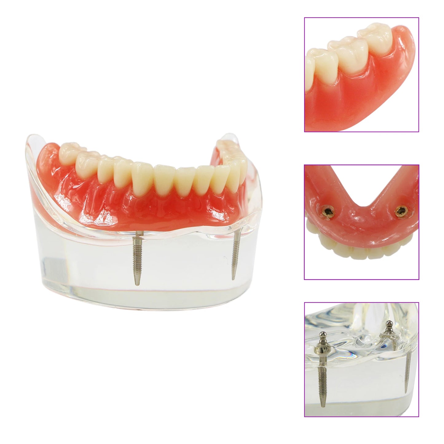 Dental Model M6002 Implant Overdenture Study Base