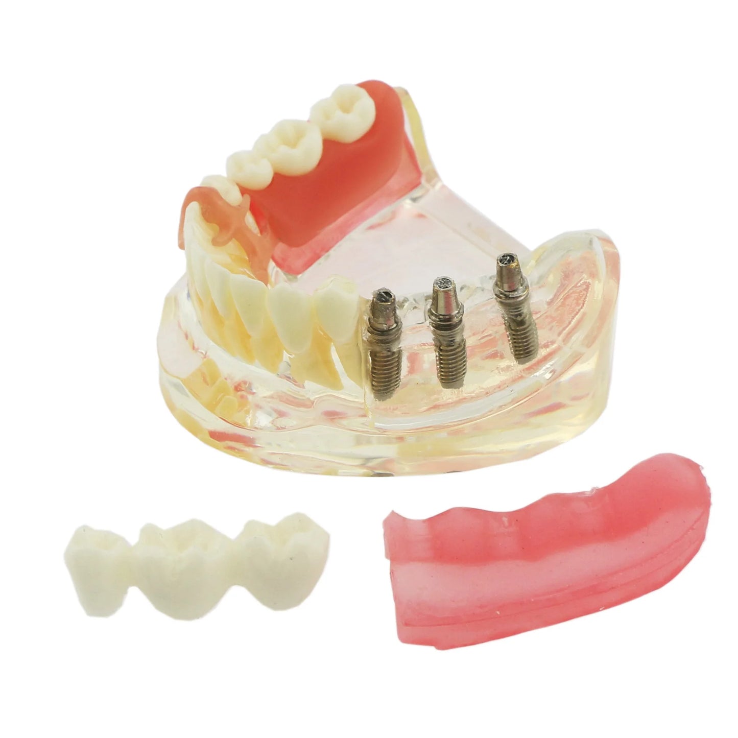 Dental Removable Bridge Partial Tooth Implant Model