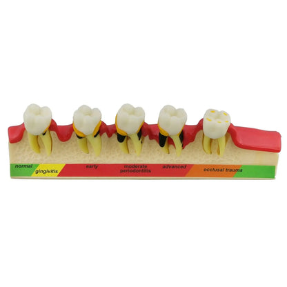 Dental Periodontal Disease Progression Model PER 4010