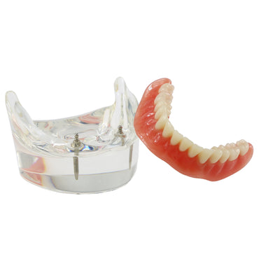 Dental Model M6002 Implant Overdenture Study Base