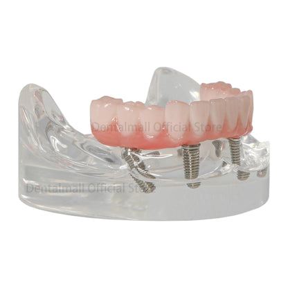 Mandibular Arch Fixed Implant Protheses Restoration Model - complete arch