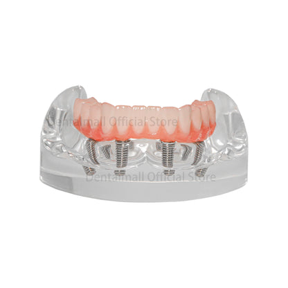 Mandibular Arch Fixed Implant Protheses Restoration Model - complete arch