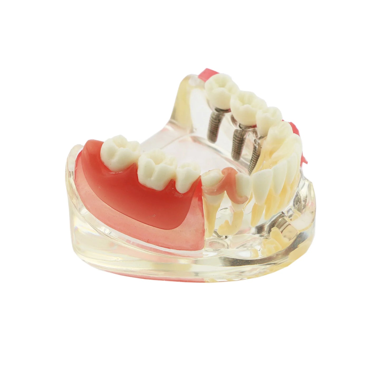 Dental Removable Bridge Partial Tooth Implant Model