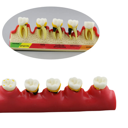 Dental Periodontal Disease Progression Model PER 4010