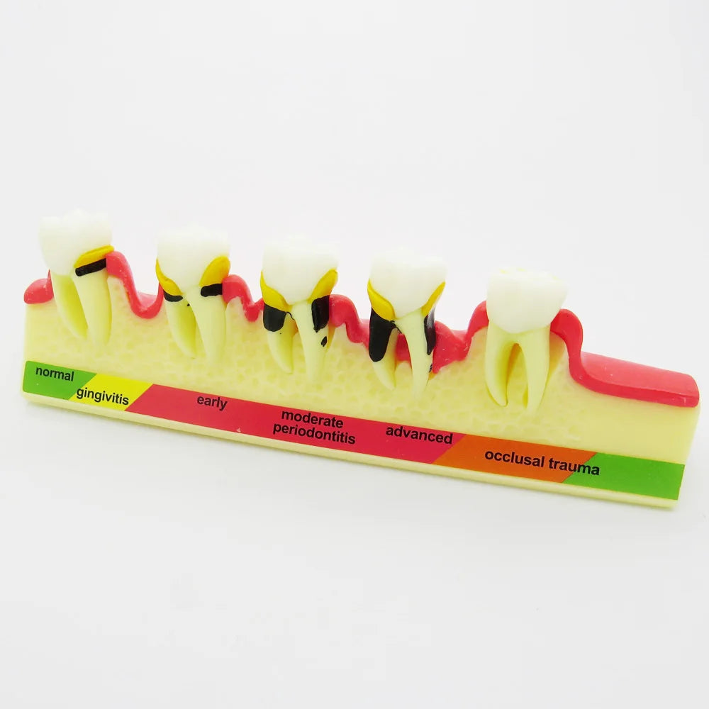 Dental Periodontal Disease Progression Model PER 4010