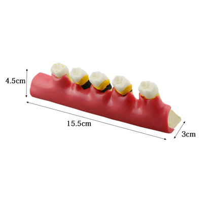 Dental Periodontal Disease Progression Model PER 4010