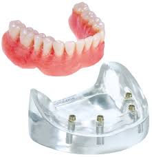 Mandibular Arch Fixed Implant Protheses Restoration Model - complete arch